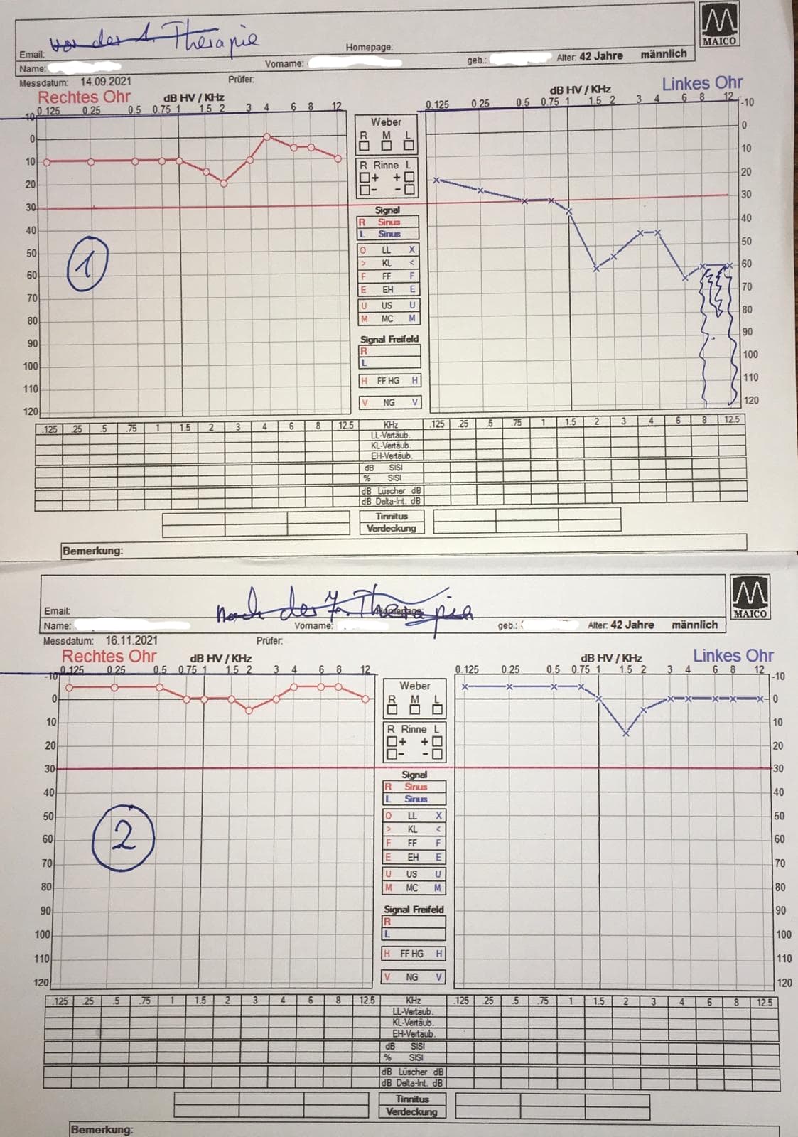 Audiogramm – Mann, 42 Jahre